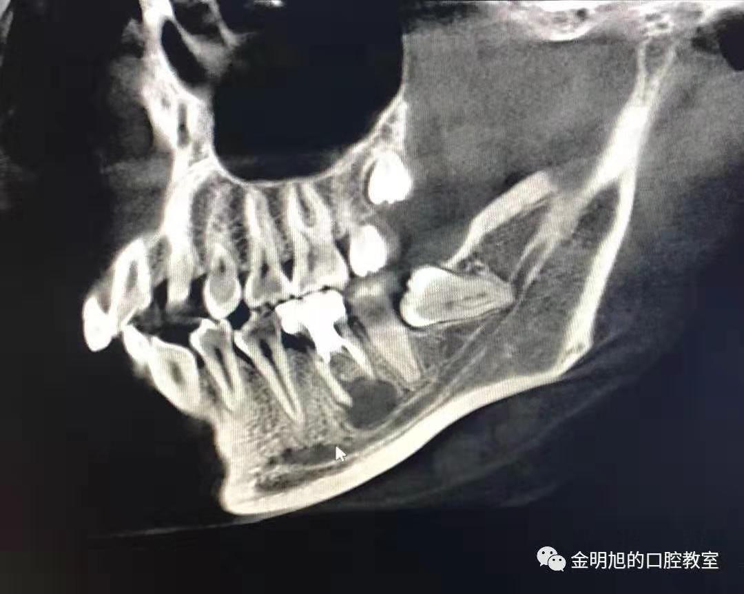 右下第一磨牙根尖囊肿(近齿槽n)摘除术一例