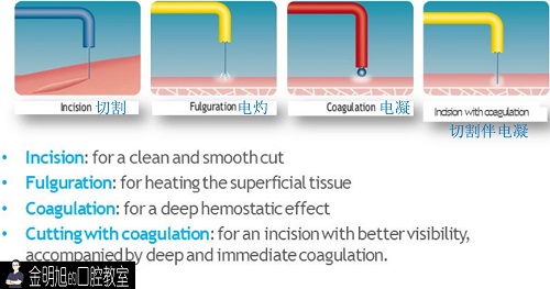 高频电刀在口腔临床中的应用 - 法国赛特力servotome
