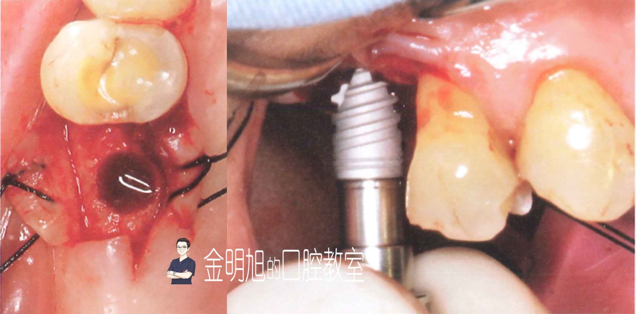 口腔种植的精准植入技巧——如何避免种植手术的毫米级误差（二）
