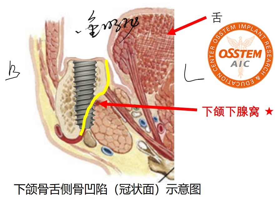 奥齿泰种植系统Master course笔记（四）