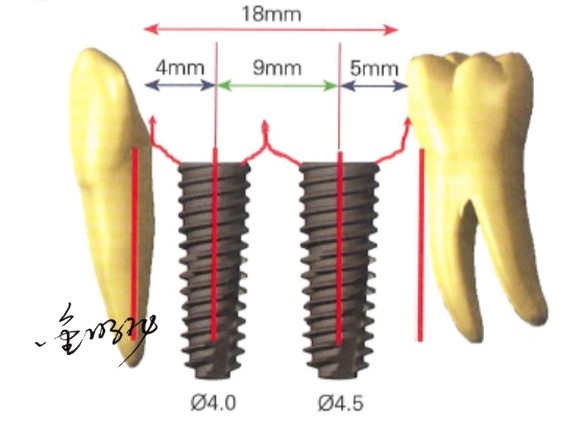 口腔种植的精准植入技巧——如何避免种植手术的毫米级误差（七）