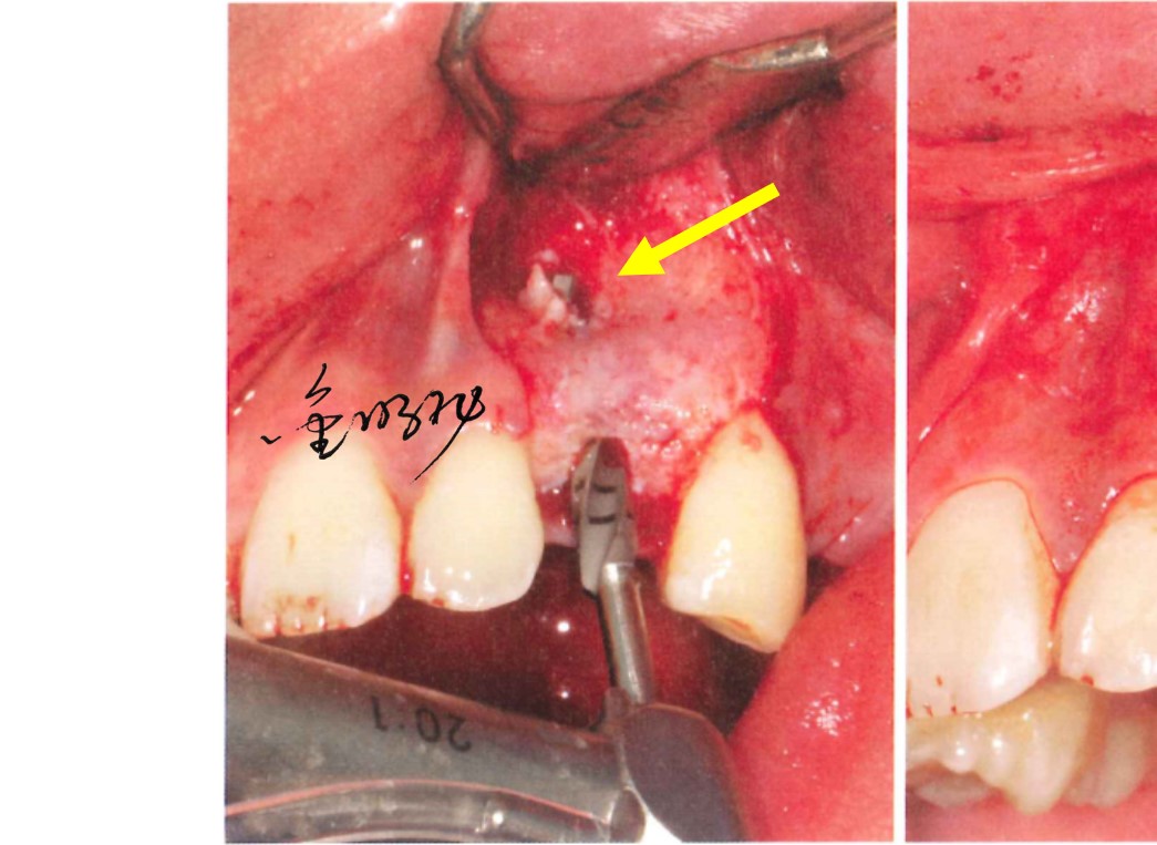 口腔种植的精准植入技巧——如何避免种植手术的毫米级误差（十一）