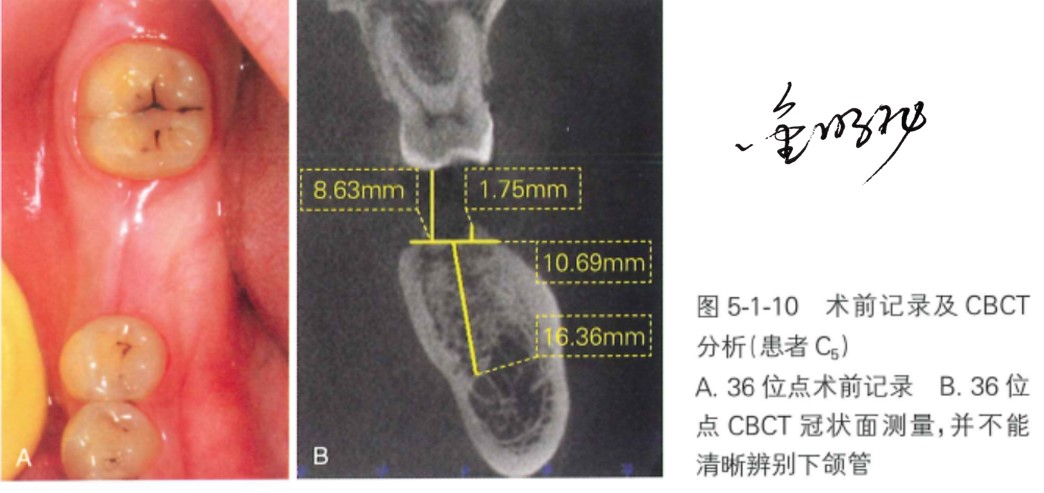 口腔种植的精准植入技巧——如何避免种植手术的毫米级误差（十五）