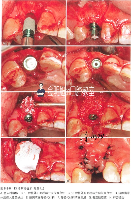 【完结篇】口腔种植的精准植入技巧——如何避免种植手术的毫米级误差（十八）
