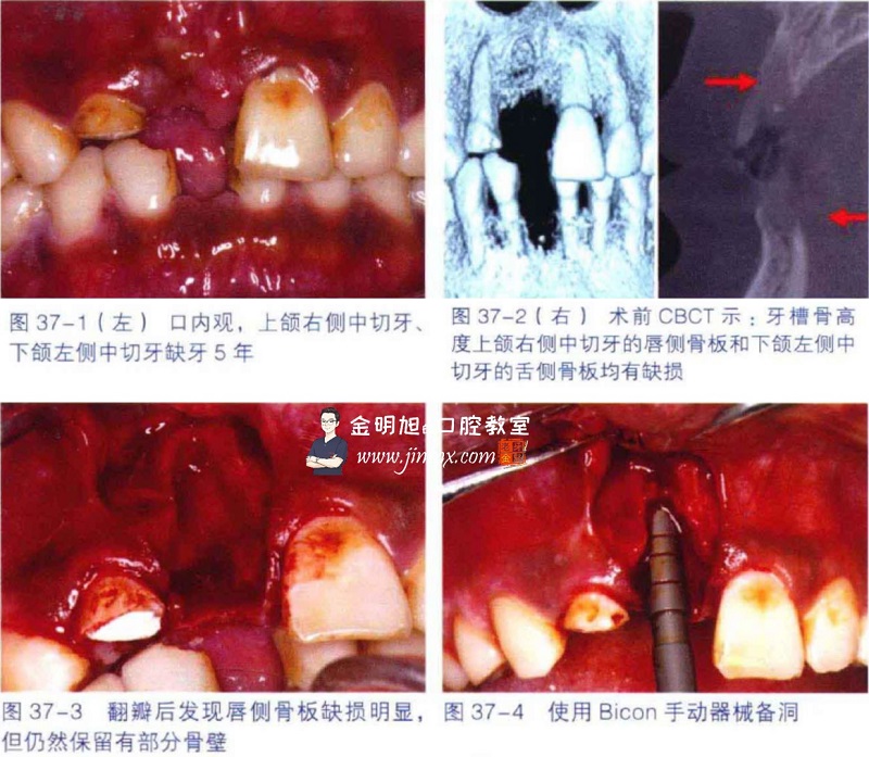 前牙区严重骨缺损应用GBR技术同期植入种植体-口腔种植临床精粹(2013年卷)