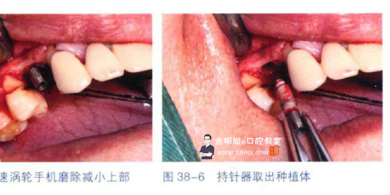 种植体取出并同期植入新种植体-口腔种植临床精粹(2013年卷)