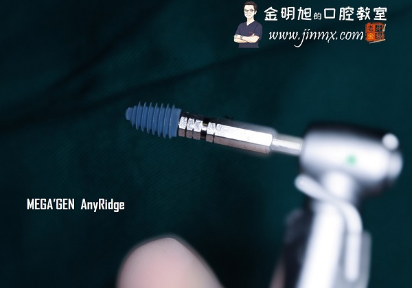 #36，37 implant with AnyRidge XPEED. by:Dr. Ming-Xu Jin