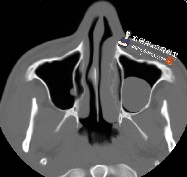 双侧后牙区游离端缺失伴单侧上颌窦黏膜囊肿的解决方案-口腔种植临床精粹(2013年卷)