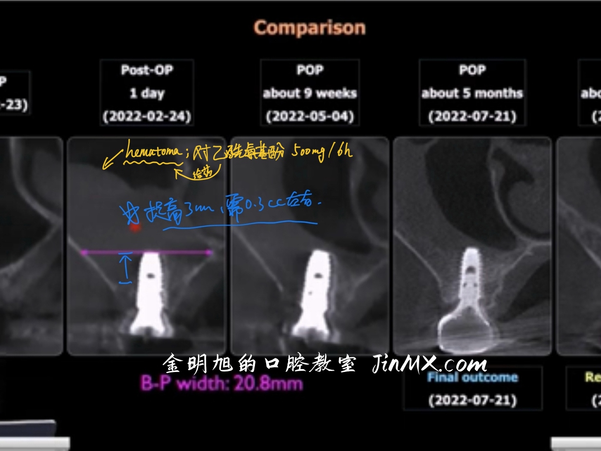 上颌窦内提升同期植骨后发生血肿伴剧烈疼痛的病例讨论。